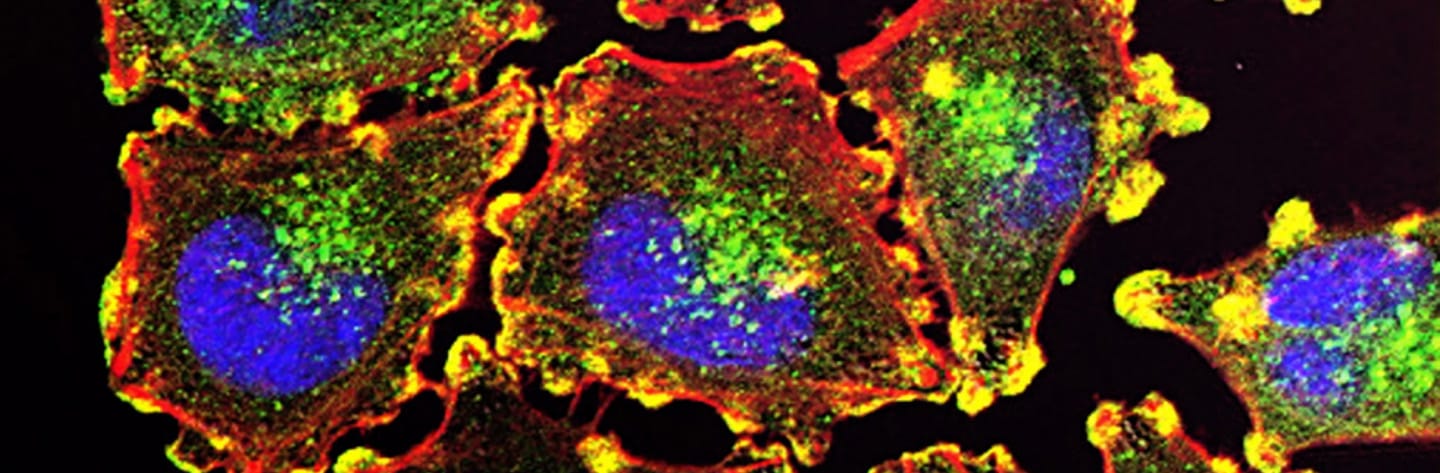 Metastatic Melanoma Cells photo from the National Cancer Institute